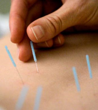 acupuntura lumbalgia